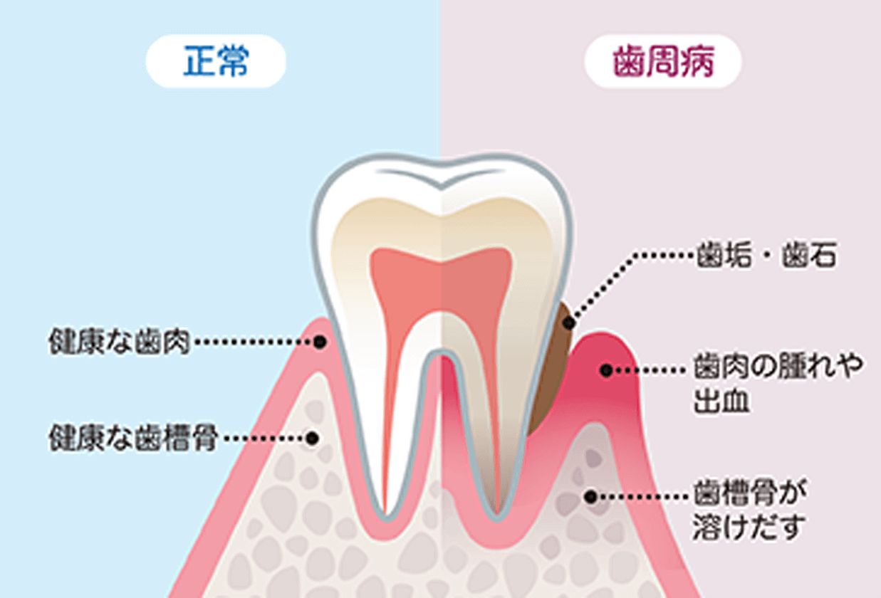 正常な歯と歯周病の歯の比較表
